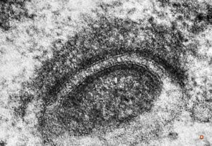 M,12y. | germinoma - intracellular desmosom